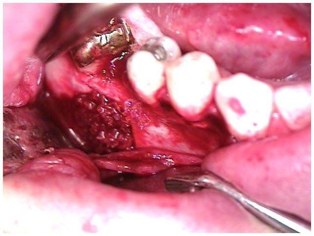 Irradiated Cancellous