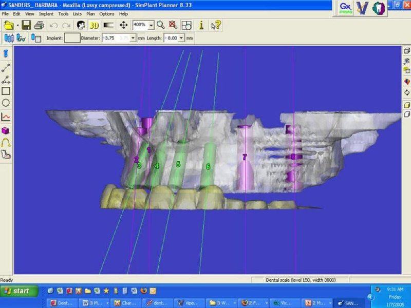 Pre-Operative Simplant 3-D