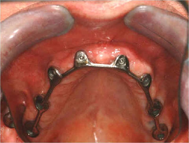 Overdenture