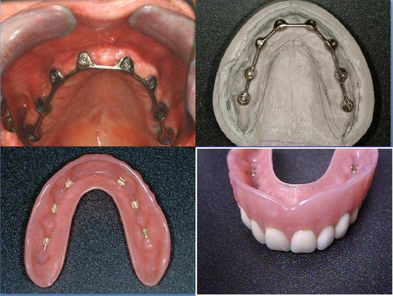 Overdenture2