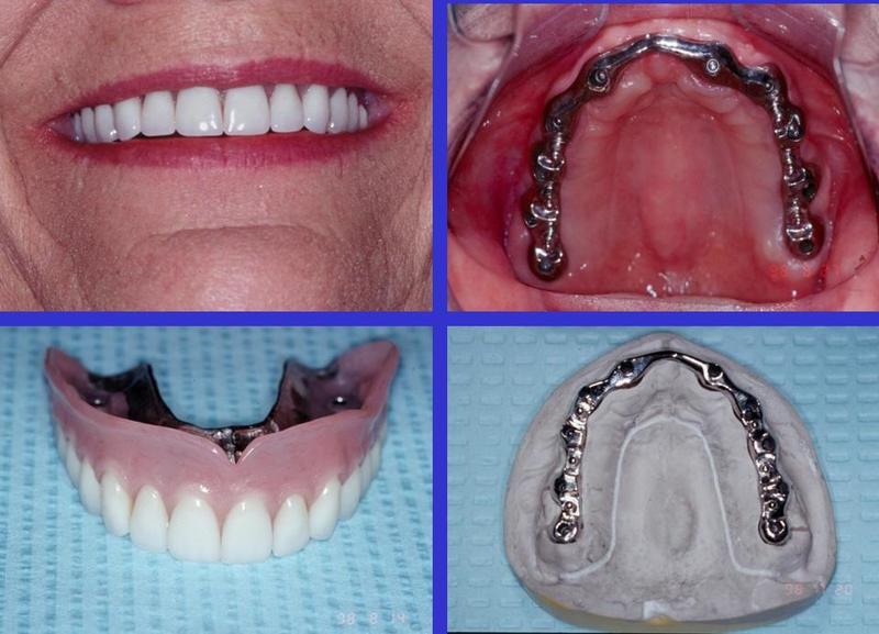 Overdenture3