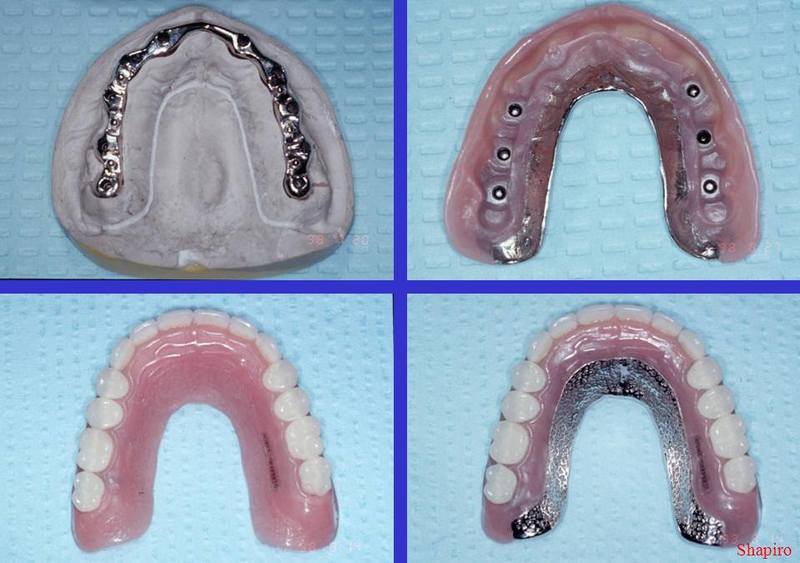 Overdenture4