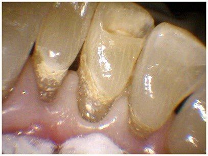 Pin Bonded Restorations(1)