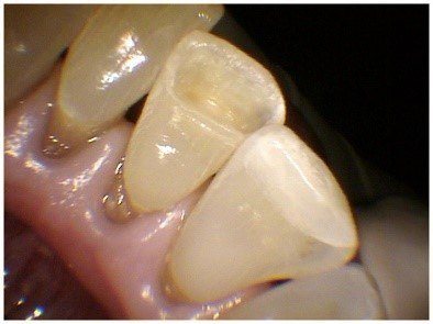 Pin Bonded Restorations(2)