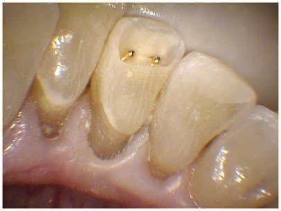 Pin Bonded Restorations(3)