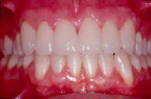 Porcelain Veneers