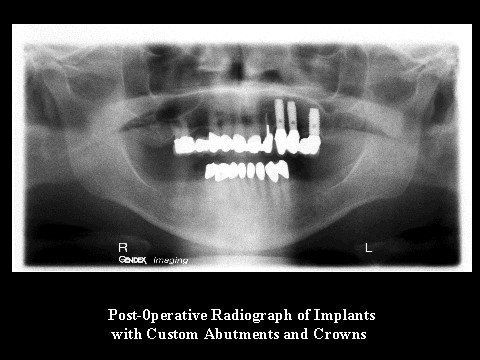 Post-Operative Radiograph (implants)