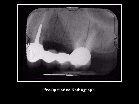 Pre-Operative Radiograph