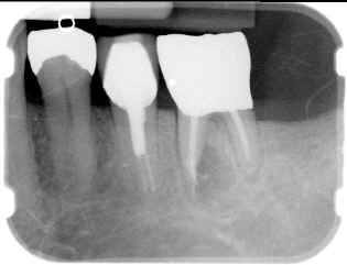 RADIOGRAPHS OF CLINICAL CASE(1)