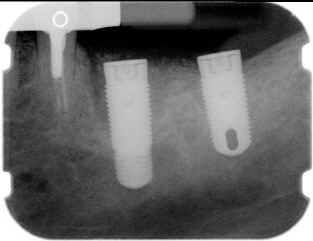RADIOGRAPHS OF CLINICAL CASE(2)
