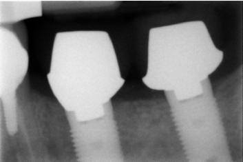 RADIOGRAPHS OF COMPLETED CLINICAL(1)