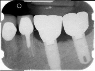 RADIOGRAPHS OF COMPLETED CLINICAL(2)