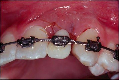 Upper Anterior5