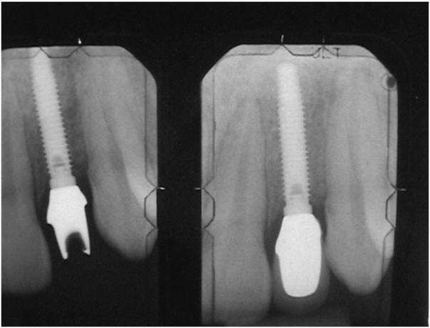 Upper Anterior9