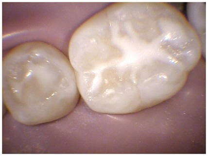 Sealants(2)
