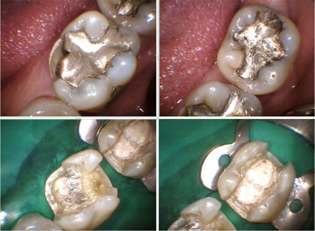 Ceramic Inlays | Dentist in Overland Park, KS