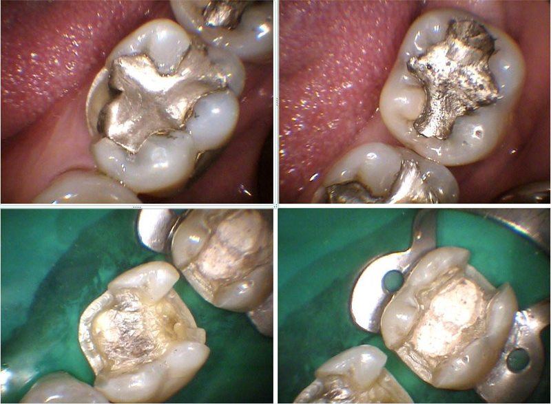 Initial Restorative Condition