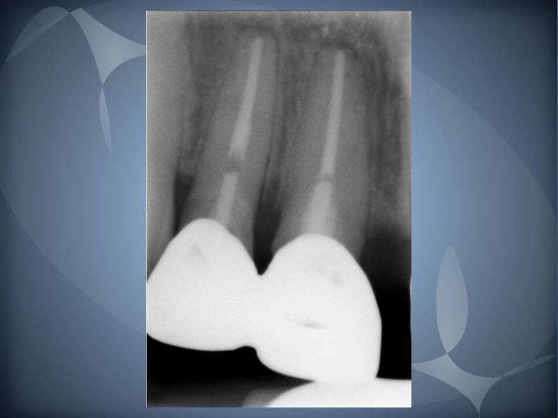 Pre-Operative Radiographs