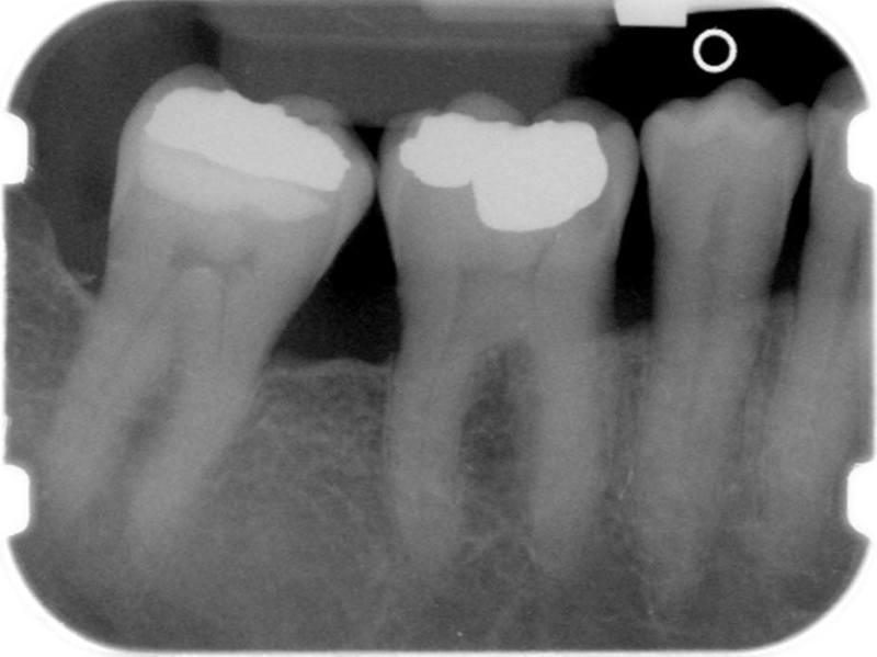 Preoperative Radiograph