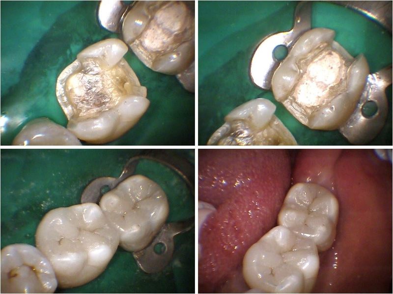 Completed Restorative Condition