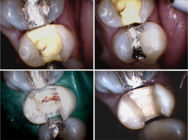 Initial Restorative Condition